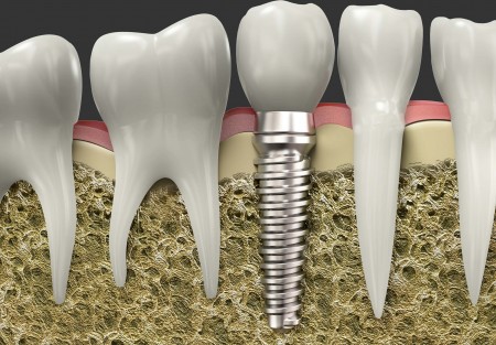 Diagram of implanted tooth