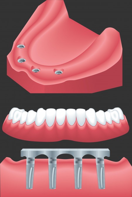 Dental implants procedure diagram